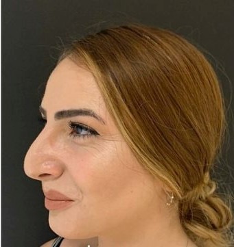 Esta mujer luce muy diferente después de someterse a una cirugía de nariz...