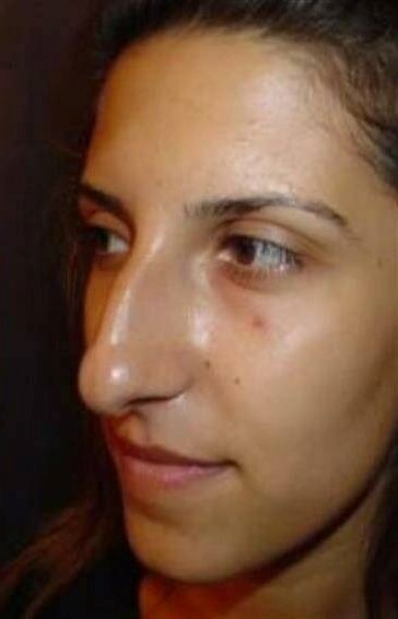 Esta mujer luce muy diferente después de someterse a una cirugía de nariz...