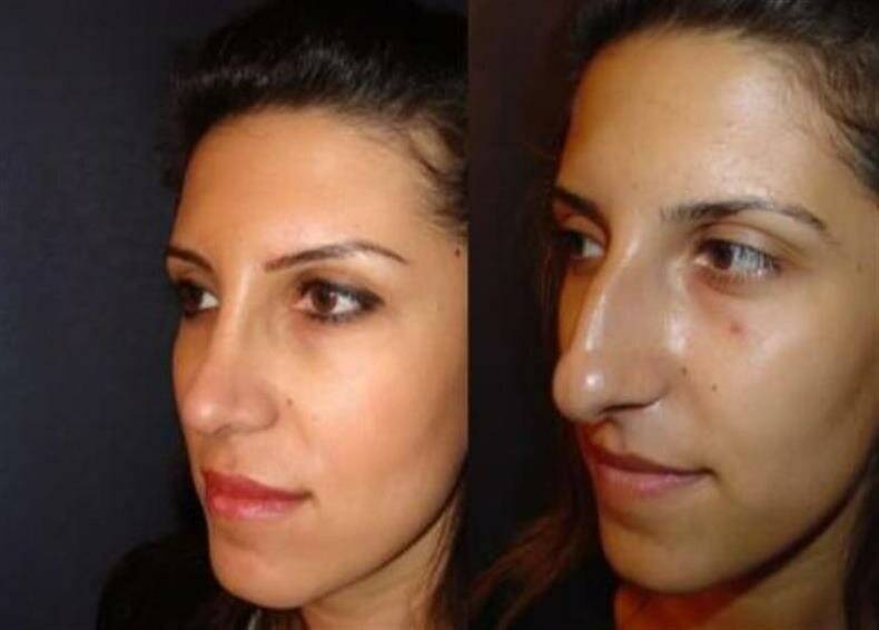 Esta mujer luce muy diferente después de someterse a una cirugía de nariz...