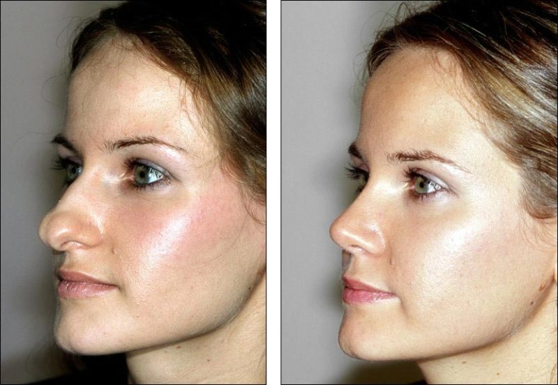 Esta mujer luce muy diferente después de someterse a una cirugía de nariz...