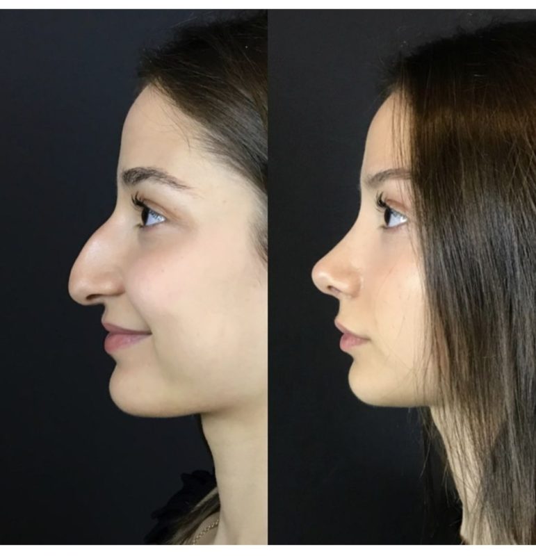Esta mujer luce muy diferente después de someterse a una cirugía de nariz...