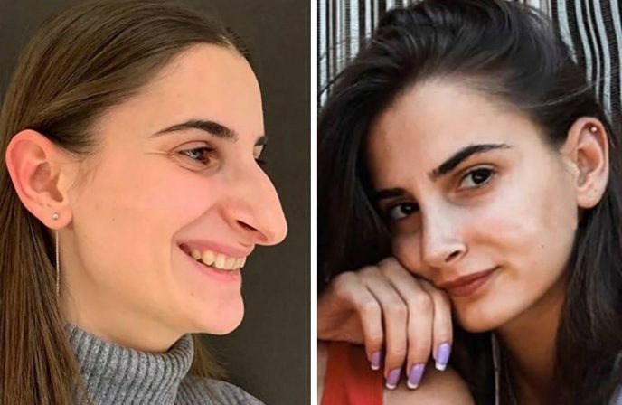 Esta mujer luce muy diferente después de someterse a una cirugía de nariz...