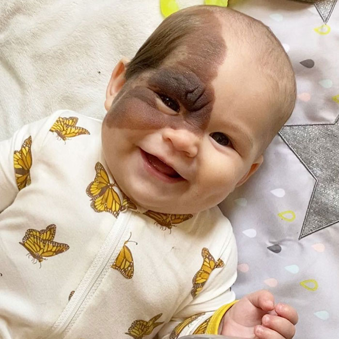Una mamá comparte la rara marca de nacimiento de su hija para demostrar algo que derrite el corazón de todos...