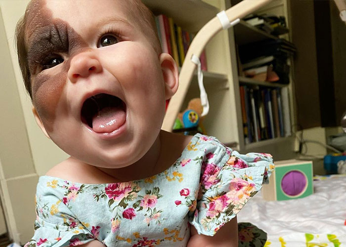 Una mamá comparte la rara marca de nacimiento de su hija para demostrar algo que derrite el corazón de todos...