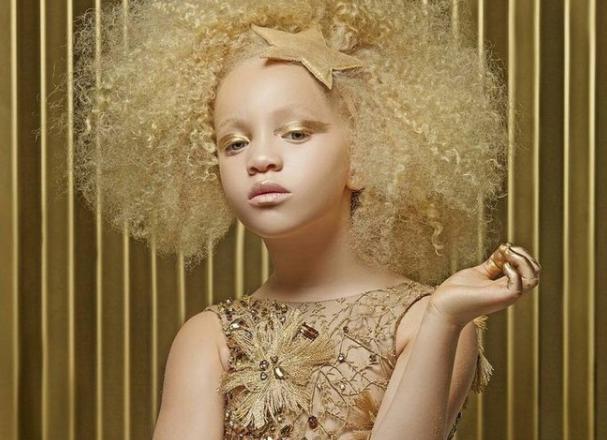 Cómo una niña albina africana ha convertido su particularidad en una virtud.