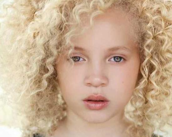 Cómo una niña albina africana ha convertido su particularidad en una virtud.