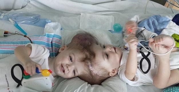 Estos gemelos siameses fueron separados cuando eran bebés, y aquí está cómo lucen a los 7 años de edad...