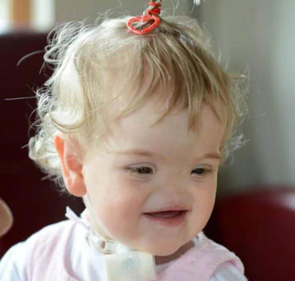 Este bebé nació sin nariz y aquí tienes cómo se ve después de 9 años... Es realmente hermosa...