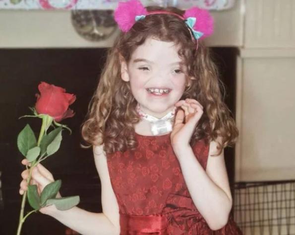 Este bebé nació sin nariz y aquí tienes cómo se ve después de 9 años... Es realmente hermosa...