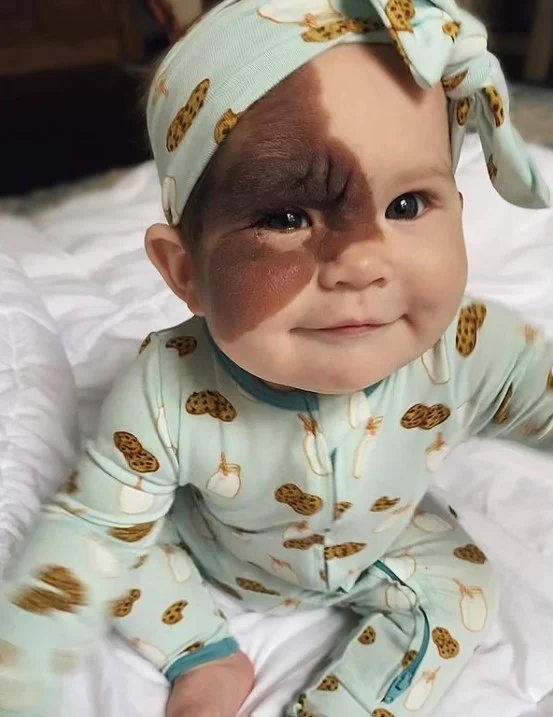 "Ella puede hacer cualquier cosa." Mamá comparte la belleza de la marca de nacimiento de su hija con el mundo.