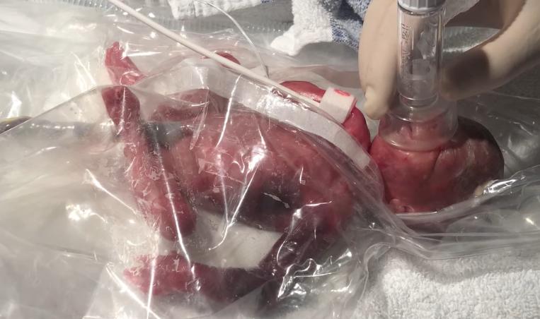 Los trillizos nacidos prematuramente superaron con éxito todas las dificultades y finalmente fueron dados de alta del hospital, regresando a casa.