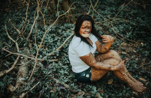 Una enfermedad rara privó a la niña de la mitad de su rostro. A pesar de esto, encontró su felicidad.