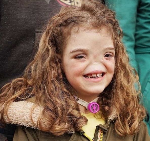 Hace ocho años, Internet quedó asombrado por la historia de esta chica que nació sin nariz. Eche un vistazo a cómo vive en la actualidad.