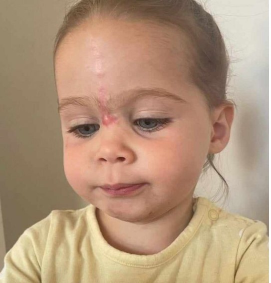 "Imágenes de una niña con un lunar desde su nacimiento hasta el proceso de su eliminación: fotografías de su desarrollo."