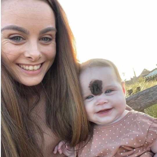 "Imágenes de una niña con un lunar desde su nacimiento hasta el proceso de su eliminación: fotografías de su desarrollo."