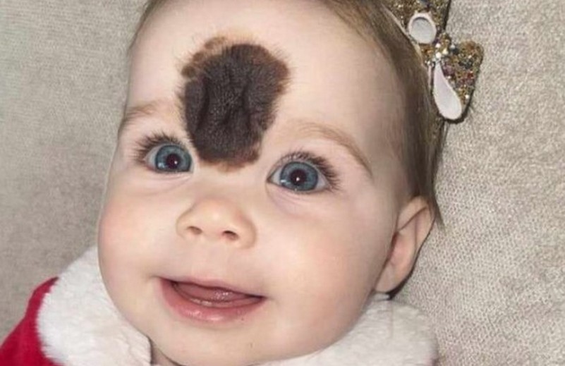 "Imágenes de una niña con un lunar desde su nacimiento hasta el proceso de su eliminación: fotografías de su desarrollo."