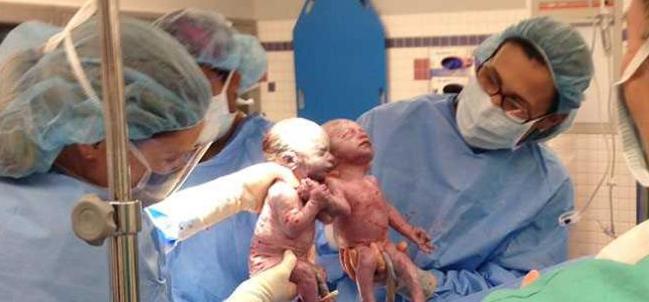 Las niñas que llegaron al mundo tomadas de la mano experimentaron cambios significativos.