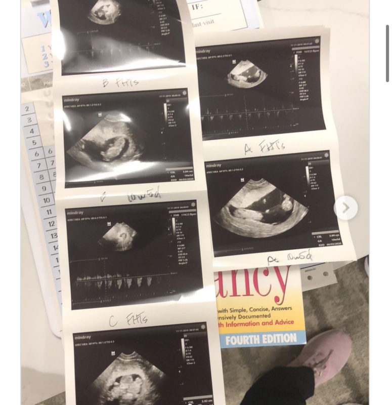 1 entre 15 millones de probabilidades: mujer da a luz a cuatrillizos sin utilizar fertilidad, luego el médico nota algo muy especial.