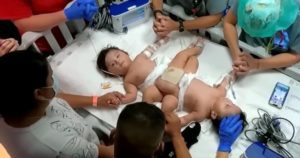 Padres y equipo médico rezan por gemelos unidos momentos antes de una cirugía de 17 horas, expresan gratitud mientras los gemelos regresan a casa sanos.