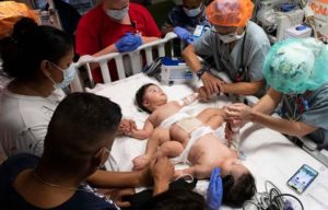 Padres y equipo médico rezan por gemelos unidos momentos antes de una cirugía de 17 horas, expresan gratitud mientras los gemelos regresan a casa sanos.
