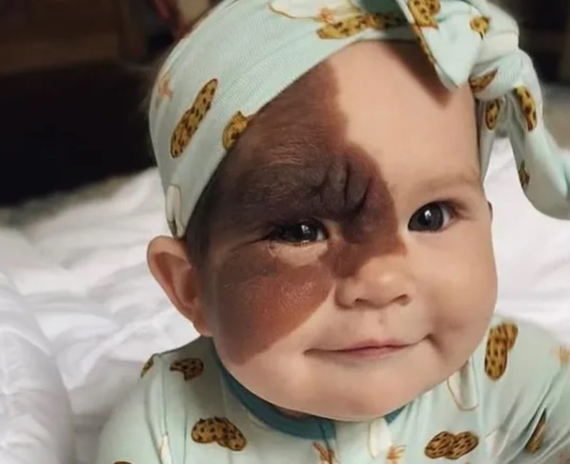 "Ella puede hacer cualquier cosa". Mamá comparte la belleza de la marca de nacimiento de su hija con el mundo.