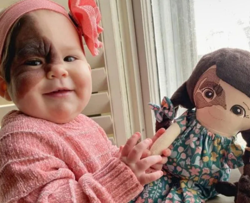 "Ella puede hacer cualquier cosa". Mamá comparte la belleza de la marca de nacimiento de su hija con el mundo.