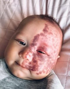 "La verdadera motivación detrás de la decisión de una madre: la eliminación del lunar de su hijo con láser genera críticas."