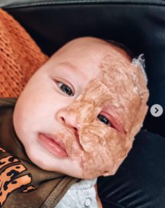 "La verdadera motivación detrás de la decisión de una madre: la eliminación del lunar de su hijo con láser genera críticas."