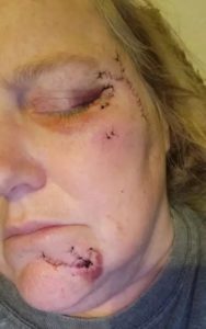 Abuela intrépida pone en su sitio a un Pitbull, paga el precio mientras protege a sus nietos pequeños. Echa un vistazo a su advertencia a todos los padres.