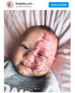 La verdadera motivación detrás de la decisión de una madre: Eliminar la marca de nacimiento de su hijo con láser genera críticas.