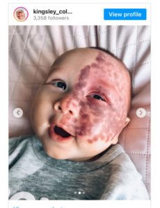 La verdadera motivación detrás de la decisión de una madre: Eliminar la marca de nacimiento de su hijo con láser genera críticas.
