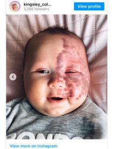 La verdadera motivación detrás de la decisión de una madre: Eliminar la marca de nacimiento de su hijo con láser genera críticas.