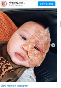 La verdadera motivación detrás de la decisión de una madre: Eliminar la marca de nacimiento de su hijo con láser genera críticas.