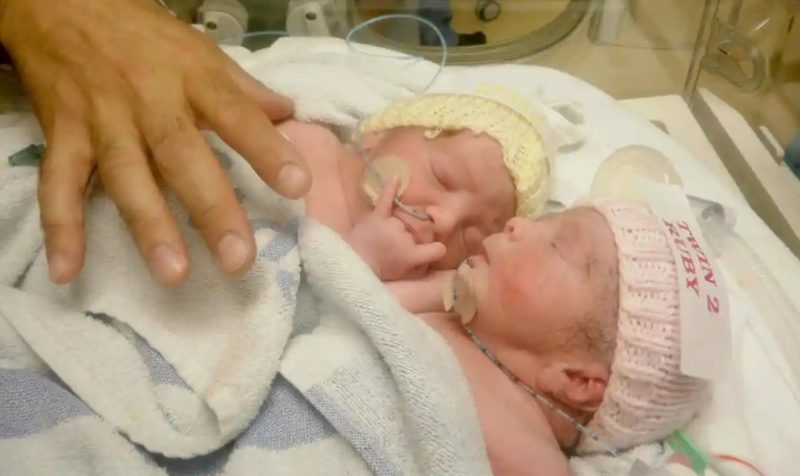Madre recibió una sombría predicción para gemelas siamesas, ¡pero prosperaron contra todo pronóstico! ¡Míralas ahora!