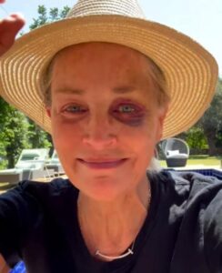 ¡Qué detalles cuenta Sharon Stone sobre el moretón bajo el ojo! ¡Noticias impactantes que no te dejarán indiferente!